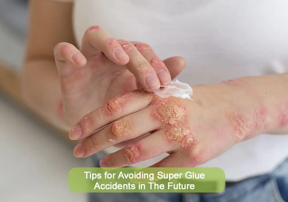 A person applying cream on a hand affected by a red, scaly skin rash